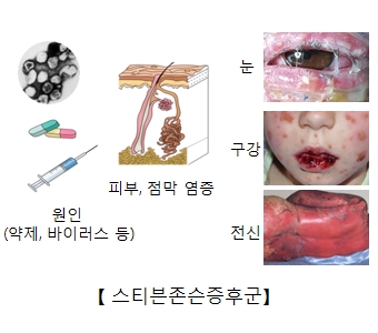 스티븐 존슨 증후군